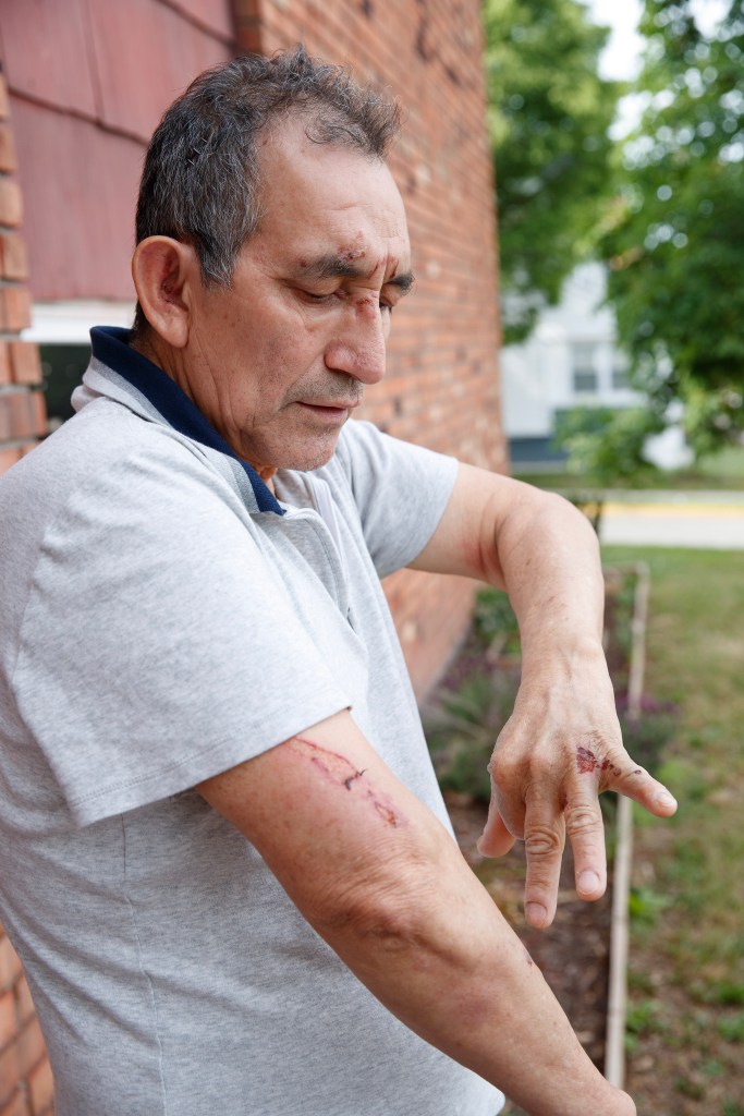 Orlando Cabrera, who was violently attacked and shoved onto subway tracks, looks down, showing injuries to his forehead, arm, and hand.