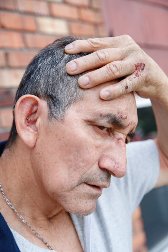 A man with multiple facial injuries and surgical staples in his scalp.