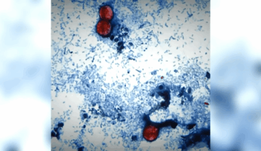 NYC cyclosporiasis update: Numbers climb; CDC issues new alert – NBC New York
