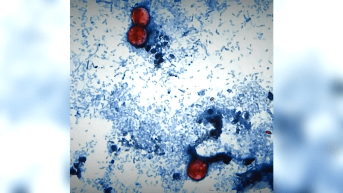 NYC cyclosporiasis update: Numbers climb; CDC issues new alert – NBC New York