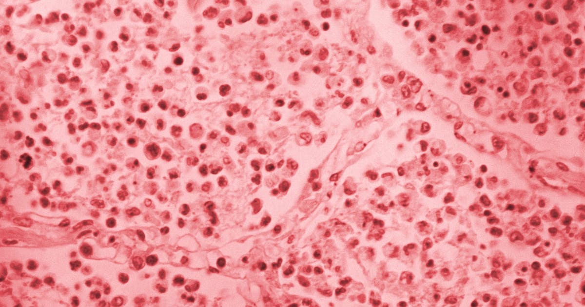 Upper East Side Legionnaires’ cluster grows to 54 cases