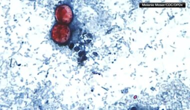 Cyclosporiasis stomach parasite: NYC sees three-fold increase in parasitic infections compared to last year