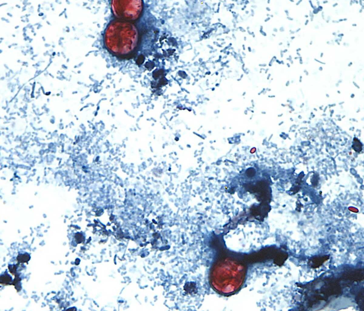 Nearly 400 New Yorkers infected with explosive diarrhea-causing parasite, cyclosporiasis. Here’s what health experts say you can do to avoid it.