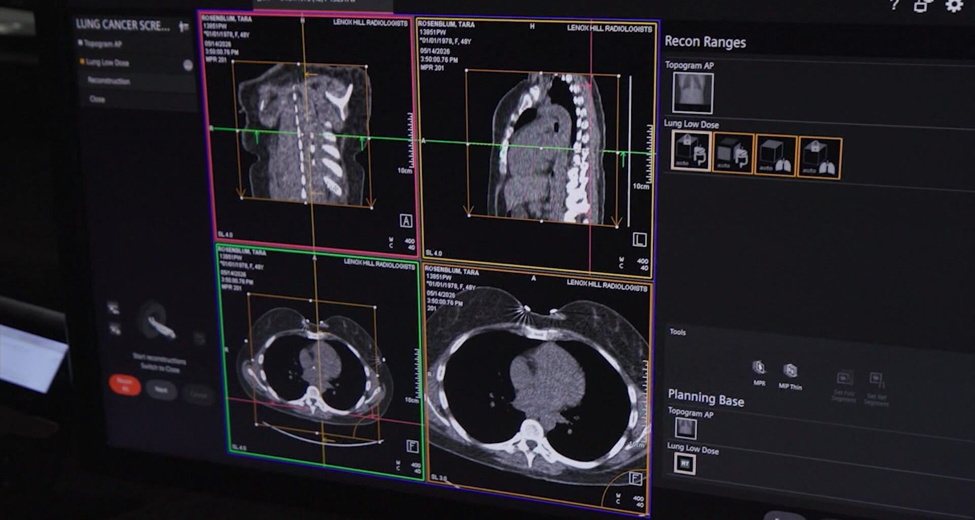 News 12 | Brooklyn | How Ai And New Tech Are Fighting The Tri States Deadliest Cancer