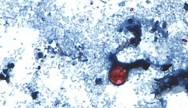 Cyclosporiasis in New York climbs to 394 cases since May 1 – NBC New York