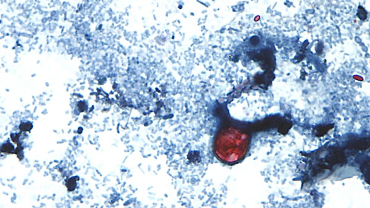 Cyclosporiasis in New York climbs to 394 cases since May 1 – NBC New York