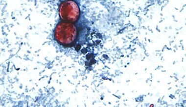 NYC health officials probe rise in cyclosporiasis cases