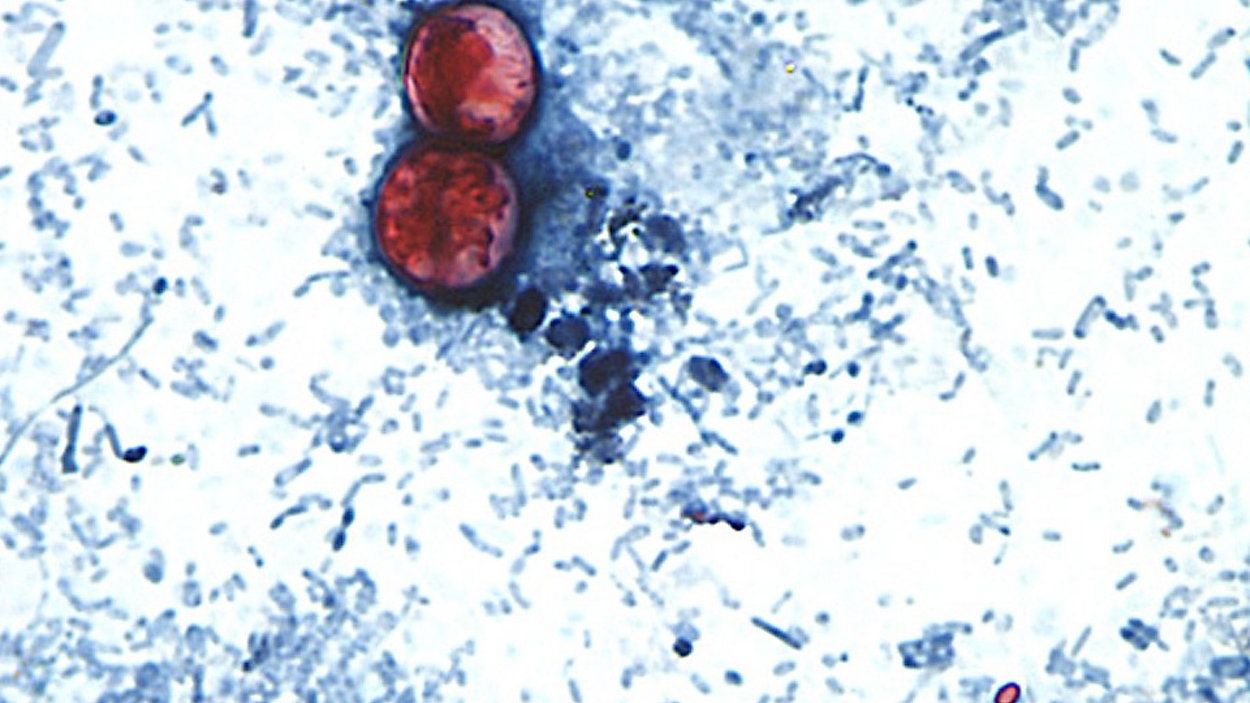 NYC health officials probe rise in cyclosporiasis cases