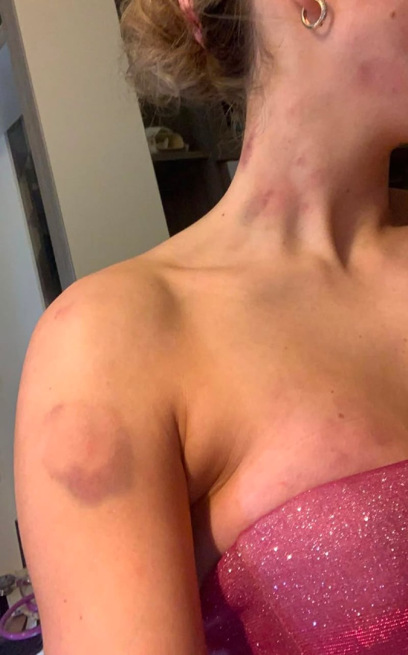 Clíodhna was left with bruises and bite marks after her ordeal at the hands of Eoin McKervey