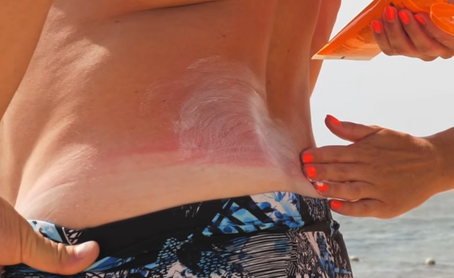 News 12 | Brooklyn | Doctor Shares Ways To Prevent Sunburn And Protect Skin During Summer
