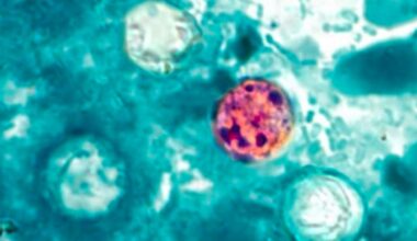 Cyclosporiasis cases climb upstate as parasite spreads
