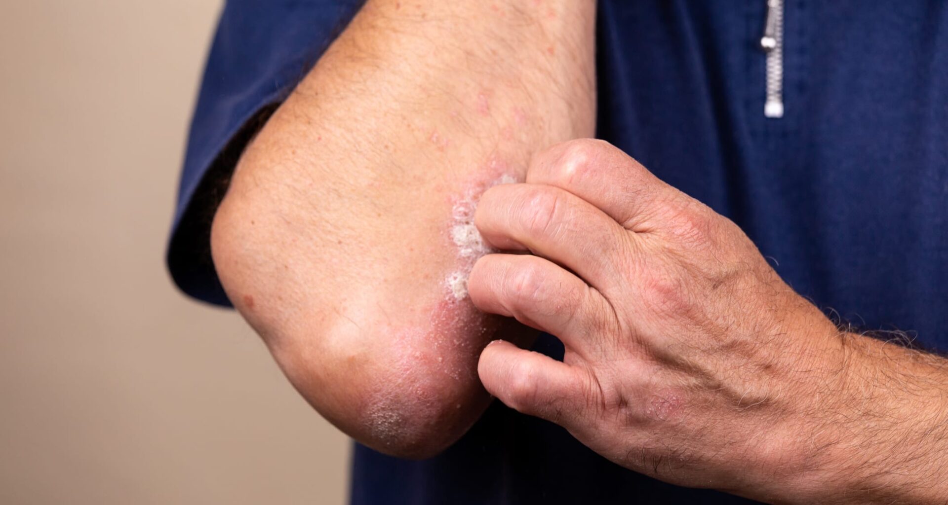 New York Approves Castle Biosciences Gene Test for Atopic Dermatitis