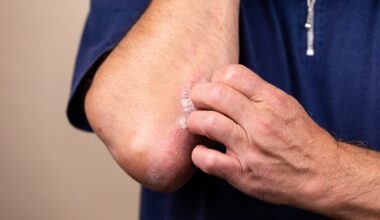 New York Approves Castle Biosciences Gene Test for Atopic Dermatitis
