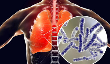 5 Dead and 82 Sickened amid Legionnaires’ Disease Outbreak in New York City’s Upper East Side
