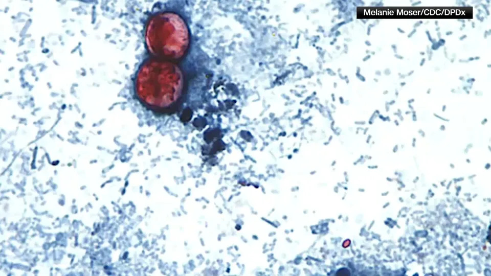 New York City sees three-fold increase in parasitic infections compared to last year