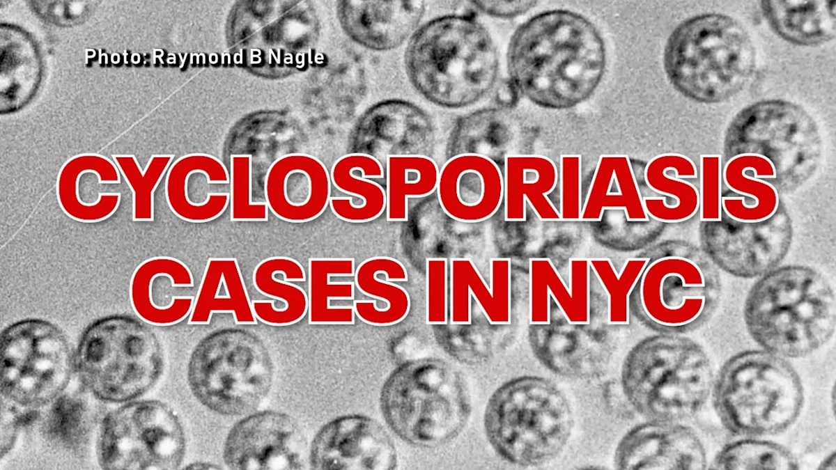 Cyclosporiasis in NYC tops 440 cases as health department investigates