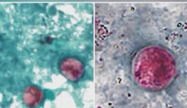 Cyclosporiasis cases triple in NYC as officials investigate possible link to leafy greens