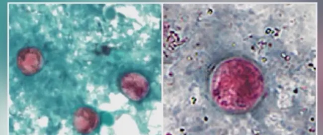 Cyclosporiasis cases triple in NYC as officials investigate possible link to leafy greens