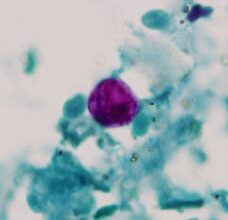 Michigan cyclospora outbreak cases eclipse 1,250
