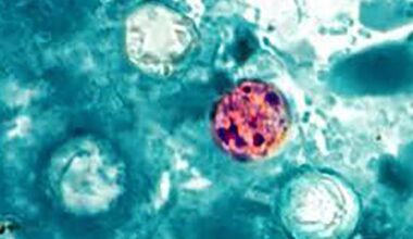 Cyclosporiasis map: 29 states now investigating diarrheal illness, including New York, New Jersey