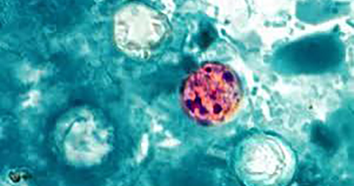 Cyclosporiasis map: 29 states now investigating diarrheal illness, including New York, New Jersey