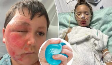 Doctor warns viral NeeDoh toy trend is hospitalizing children with severe burns