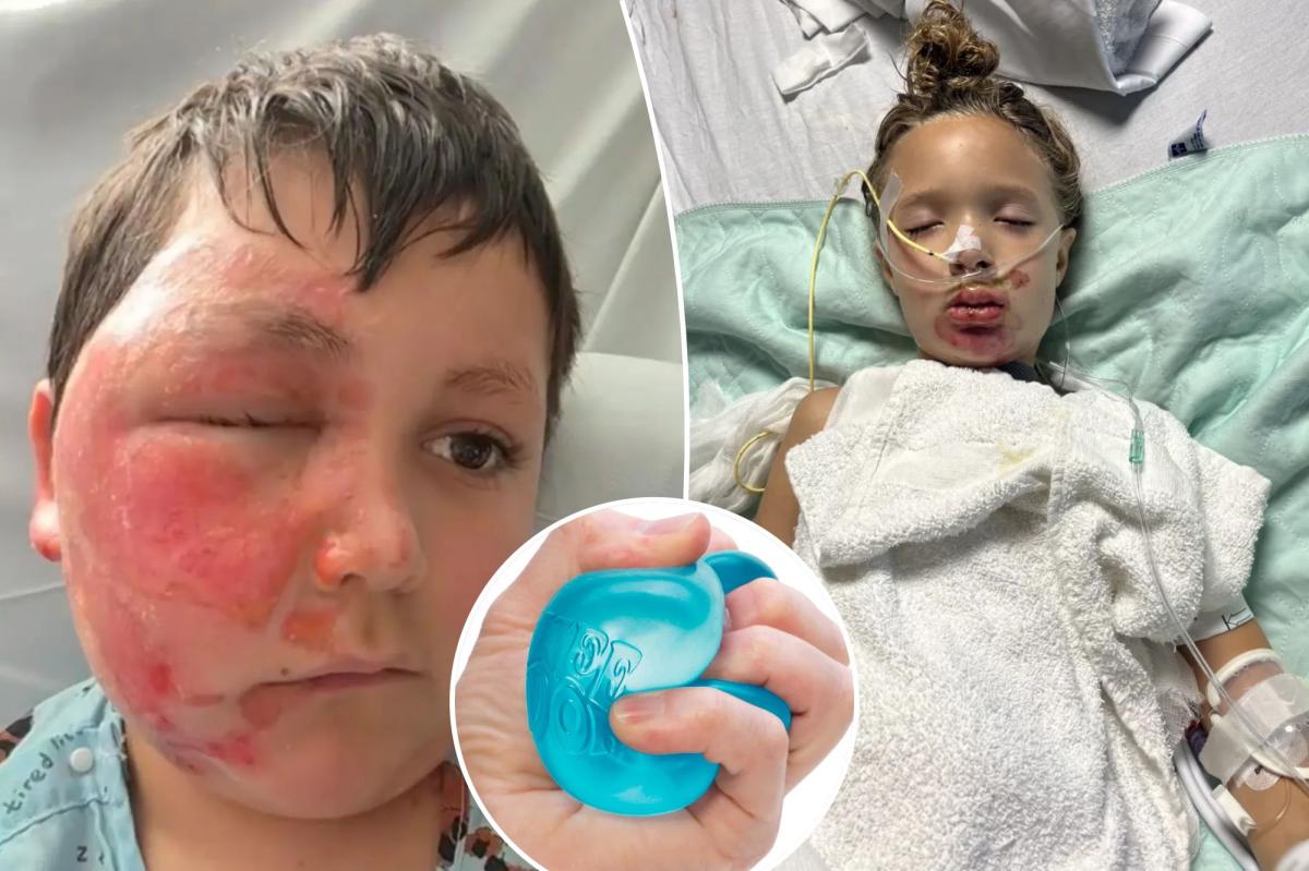 Doctor warns viral NeeDoh toy trend is hospitalizing children with severe burns