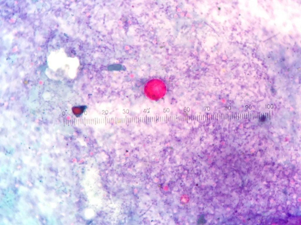 Cyclosporiasis, causing severe diarrhea, hammers New York