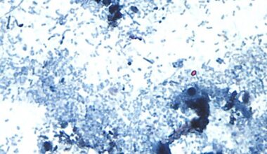 NY sees rising cases as parasite that causes severe diarrhea spreads across Midwest