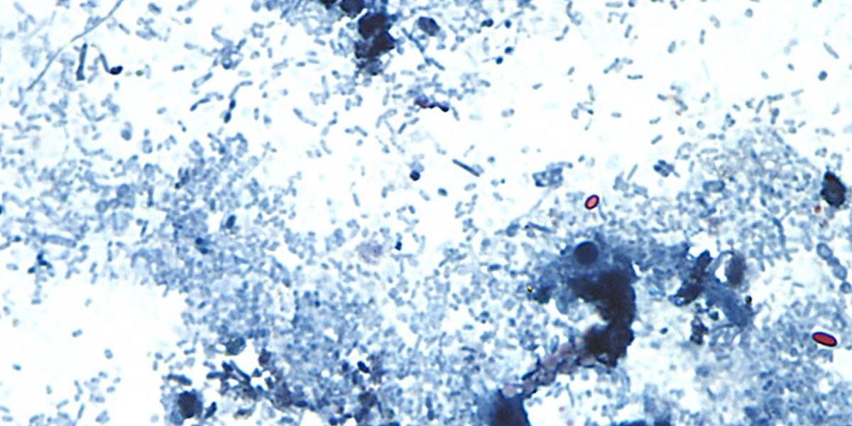 NY sees rising cases as parasite that causes severe diarrhea spreads across Midwest