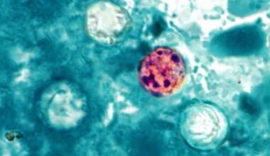 Parasite Cases In NYC: See Latest Data, Products To Avoid