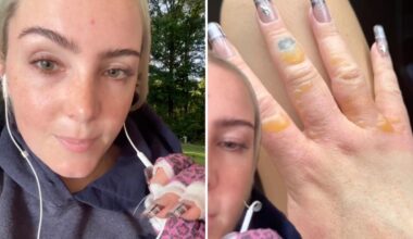 Margarita Burn: NYC woman shares urgent warning after citrus mishap