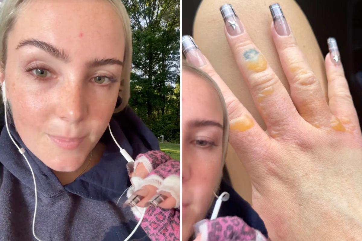 Margarita Burn: NYC woman shares urgent warning after citrus mishap