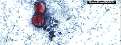 News 12 | Brooklyn | Two Deaths Linked To Cyclospora Outbreak In Michigan
