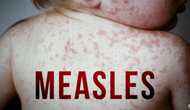 Measles cases rising in rural New York, says Jefferson Co. Public Health
