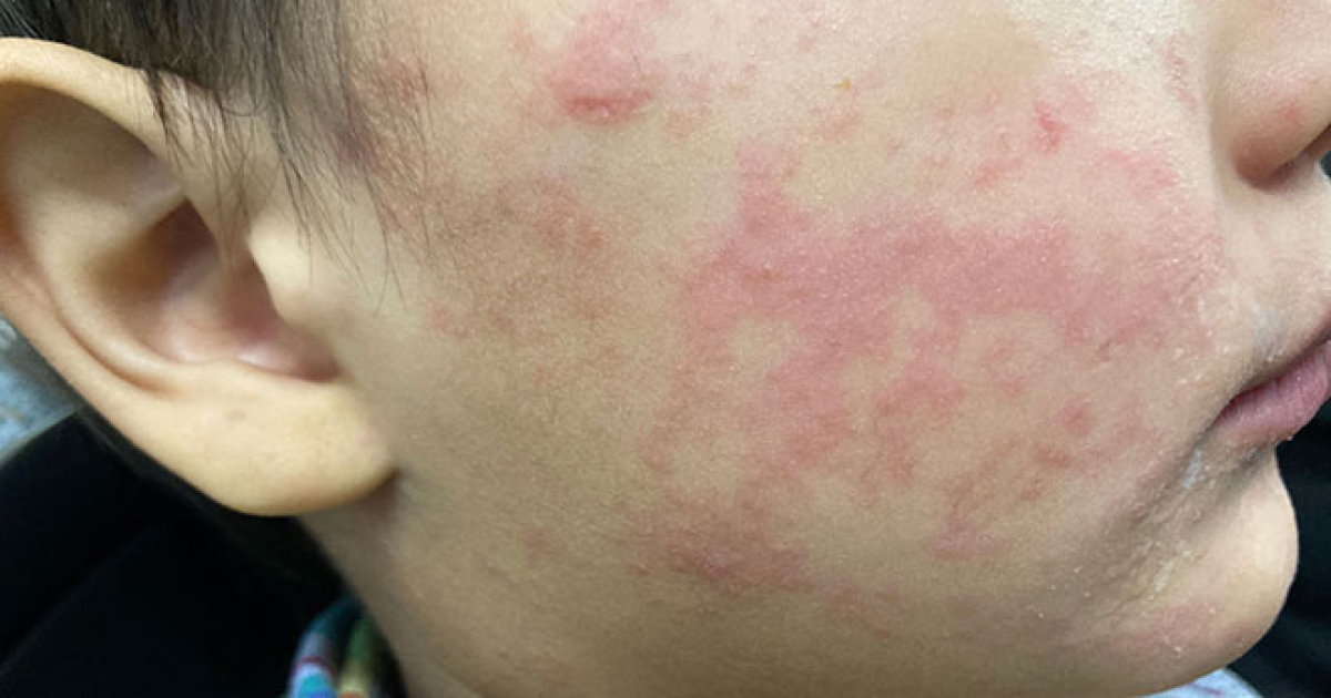 Six confirmed measles cases, 14 presumed infected across upstate NY