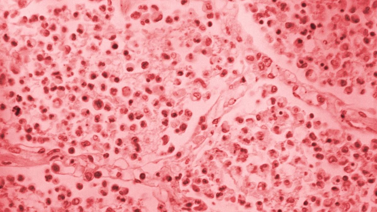 NYC Health expands Legionnaires' disease outreach area in South Bronx as testing continues