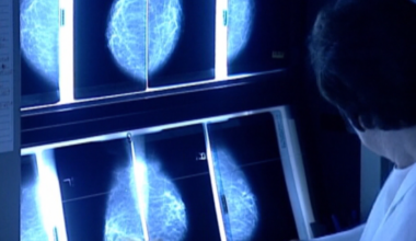 News 12 | Brooklyn | Young Women Can Get Breast Cancer Too Making Early Awareness Critical