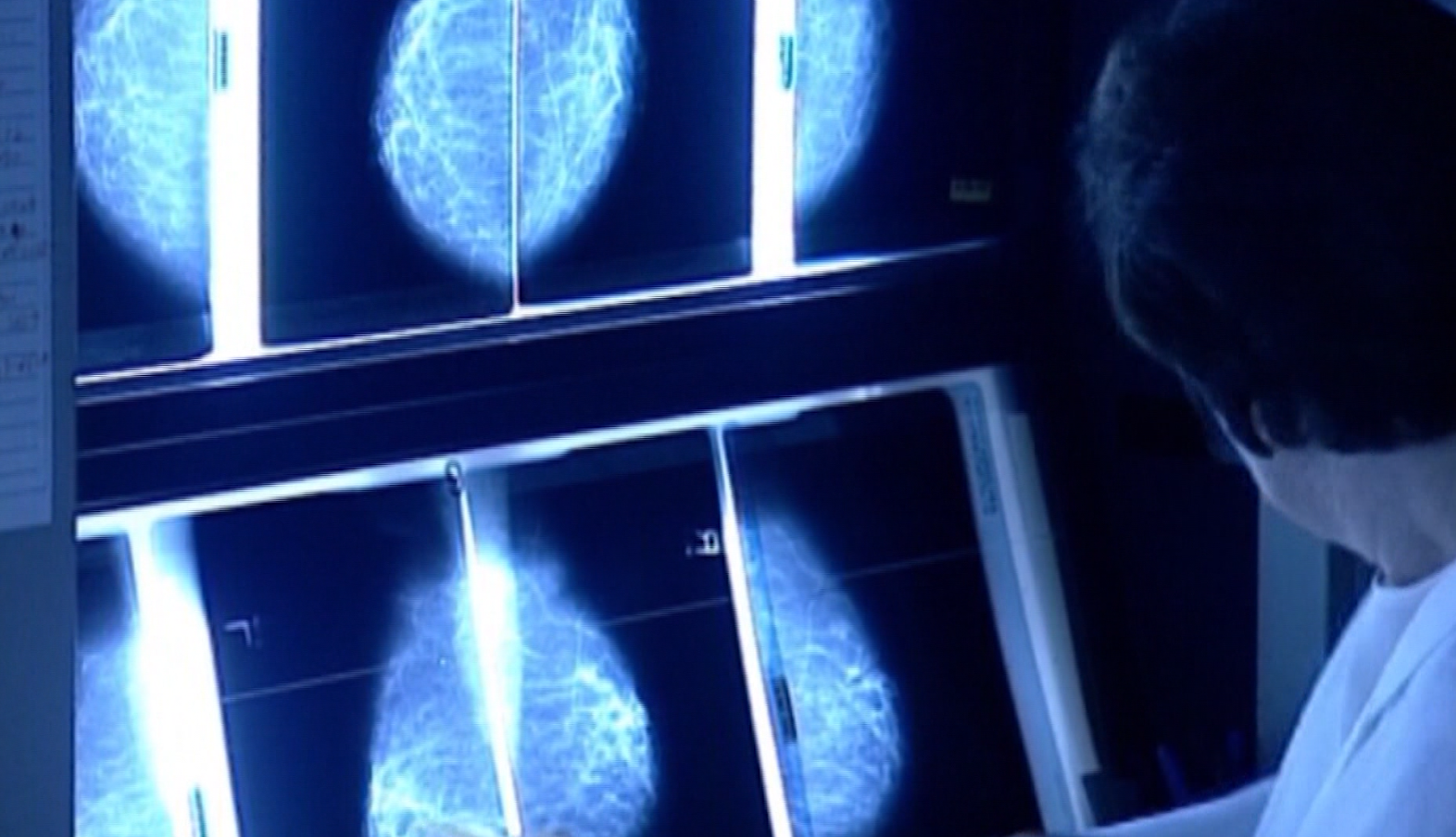 News 12 | Brooklyn | Young Women Can Get Breast Cancer Too Making Early Awareness Critical