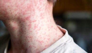 Measles outbreak in New York prompts Gov. Hochul to declare state disaster emergency