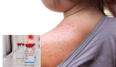 NY declares state disaster emergency over measles outbreak in rural communities