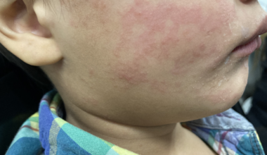 Disabilities Beat: How New York is tackling measles through a state of emergency