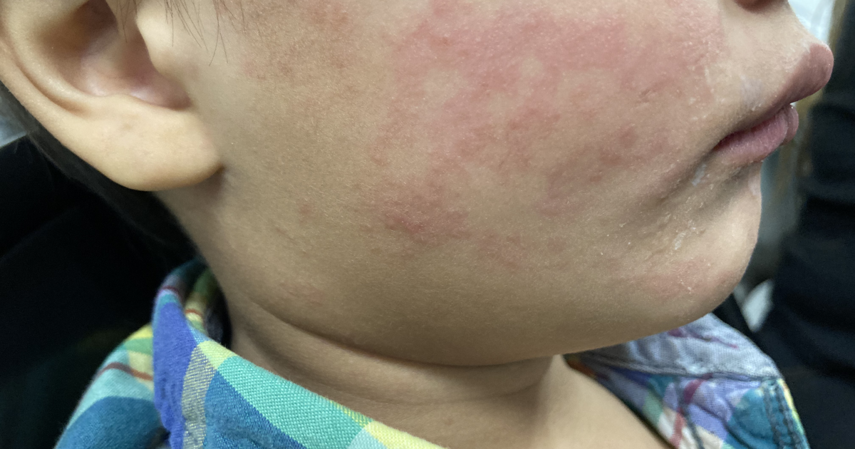 Disabilities Beat: How New York is tackling measles through a state of emergency