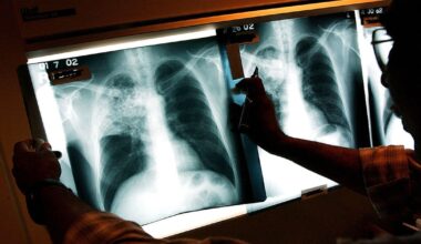 New Jersey TB case confirmed; investigation underway in Camden