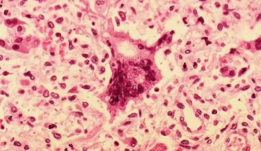 Person with measles visited car dealership and Wawa in Montgomery County, Pennsylvania health officials say