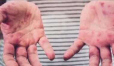 Officials warn of possible measles exposure at urgent care – NBC10 Philadelphia