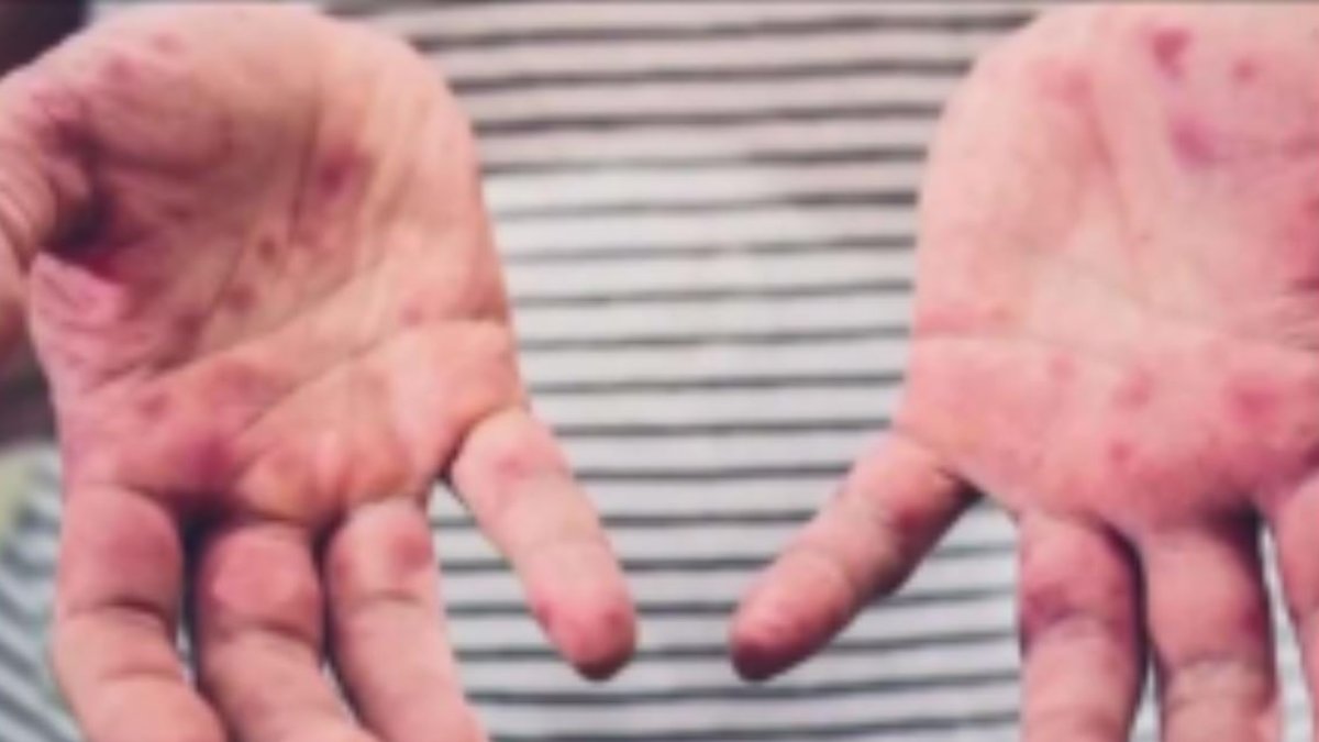 Officials warn of possible measles exposure at urgent care – NBC10 Philadelphia