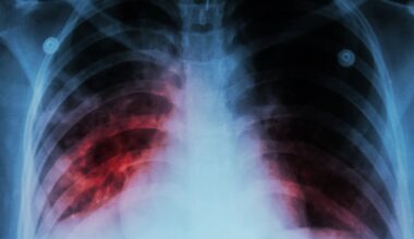 Allegheny County Health Department raising awareness of tuberculosis as cases rise across the US – WPXI