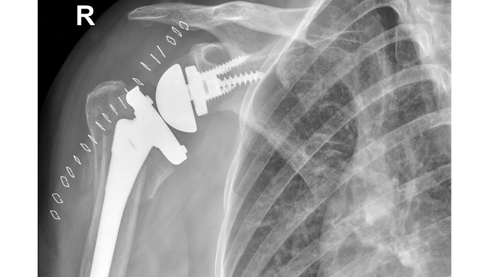 Risk indicators for hospital readmission after shoulder surgery in Pennsylvania