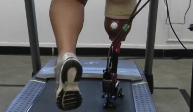 Pittsburgh company creates system to help amputees test prosthetic feet